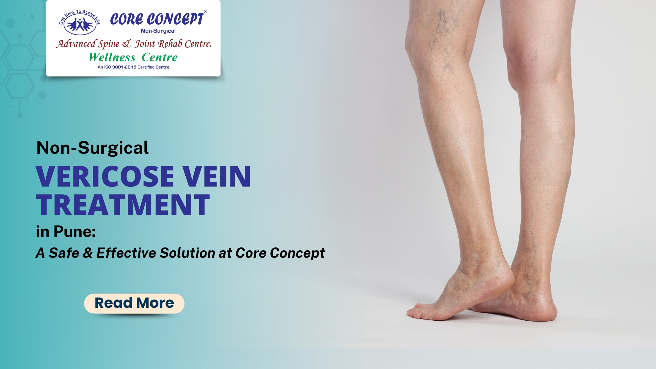 Non-Surgical Varicose Vein Treatment in Pune – A Safe & Effective Solution at Core Concept