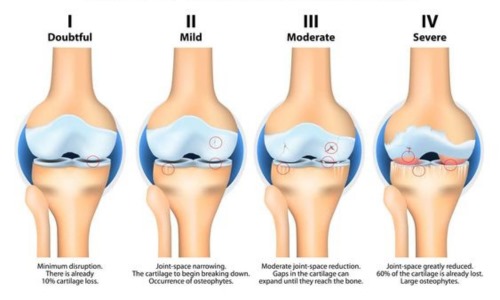 Osteoarthritis Cause of Knee pain at Core Concept