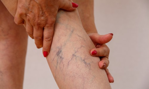  Vein Treatments at Core Concept