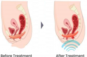 Urinary Incontinence Before After 300x197